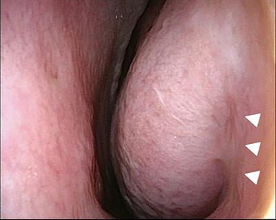Lacrimal Drainage System Obstruction Following Inferior Turbinate Surgery